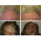 HairMax LaserCap 272 PowerFlex - bonnet laser (LASER 272)